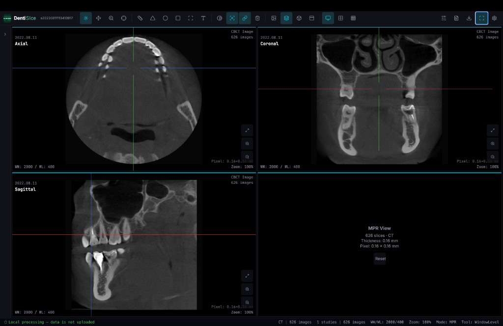 DentiSlice MPR view — axial, coronal and sagittal slices with crosshair navigation
